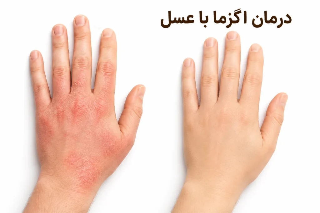عسل و درمان اگزما